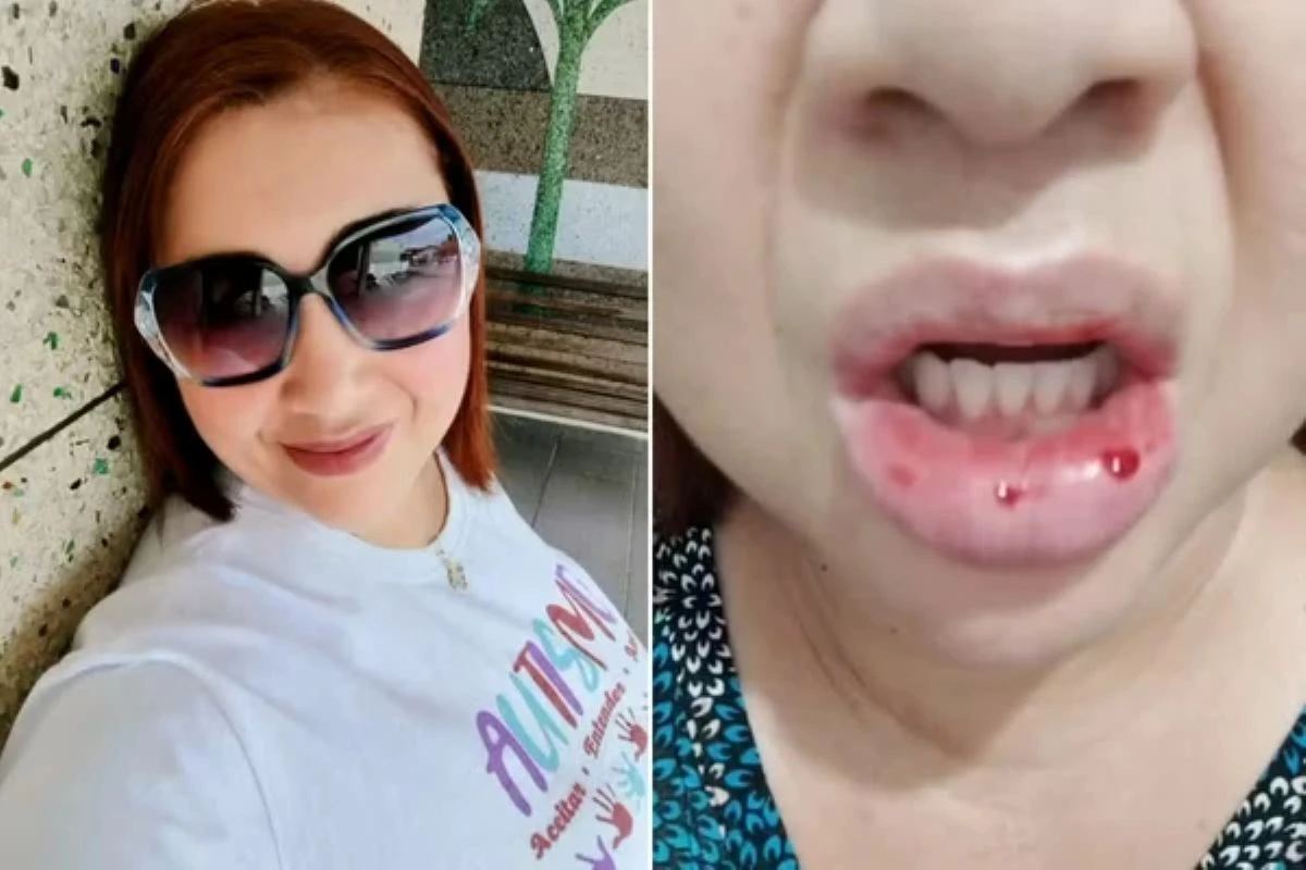Mulher processa Colgate após reação alérgica a pasta de dente