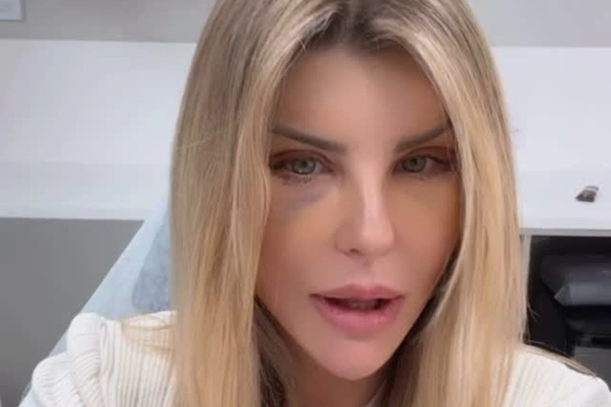 Médico explica hematomas nos olhos de Iris Stefanelli após cirurgia