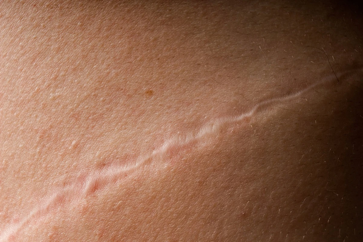 Estudo: proteína ligada ao câncer ajuda a cicatrizar feridas na pele