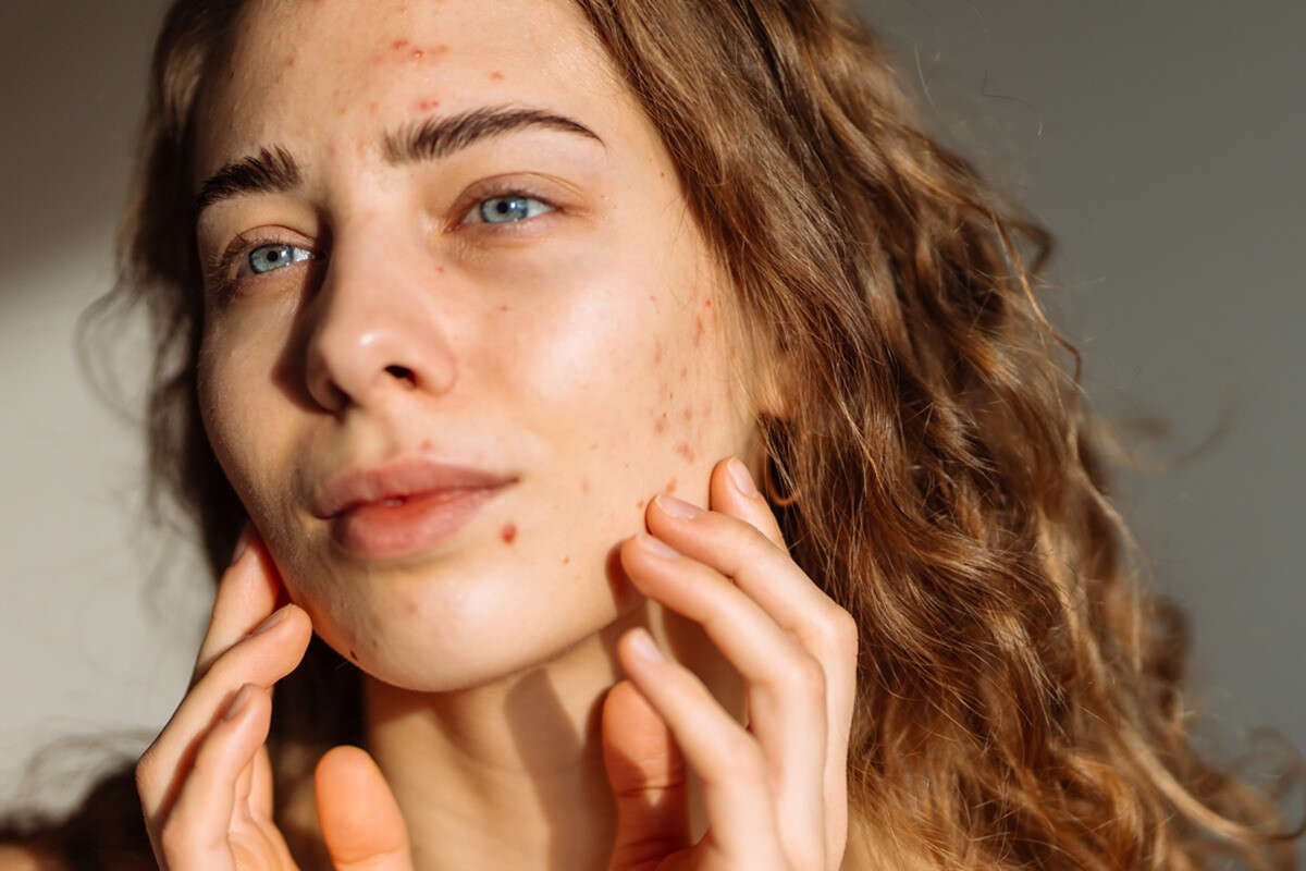 Dermatologista indica vitamina ideal para suavizar cicatrizes de acne