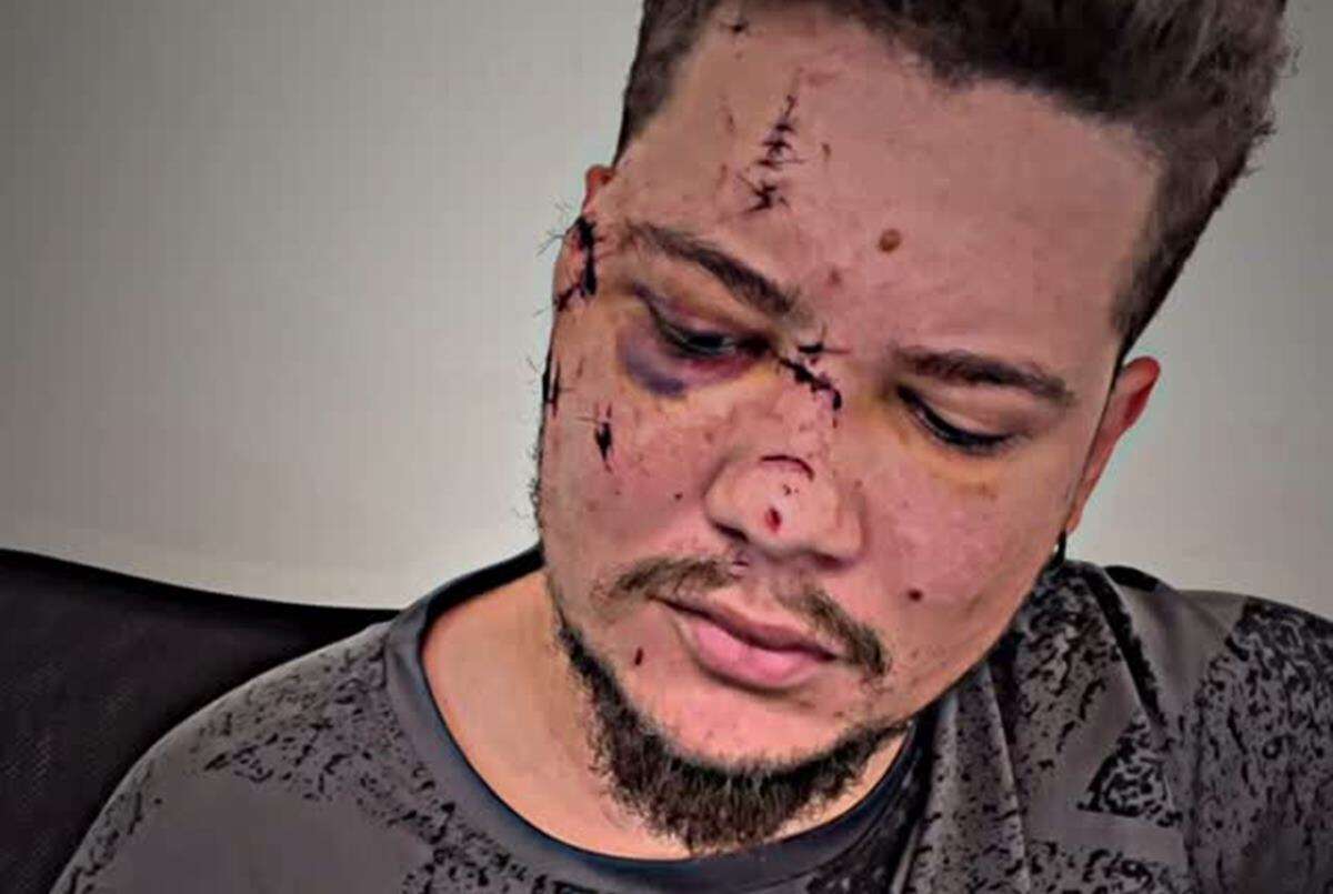 Sertanejo leva 32 pontos no rosto após ser agredido com garrafa