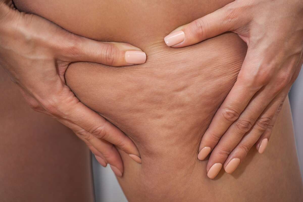 Lipedema ou celulite? Cirurgiã explica diferenças entre as condições