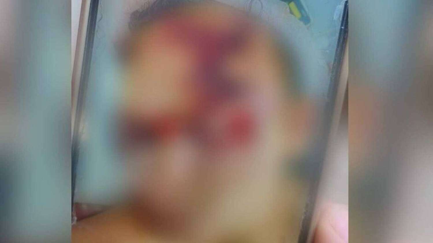 Jovem é espancado em confraternização fica com rosto desfigurado