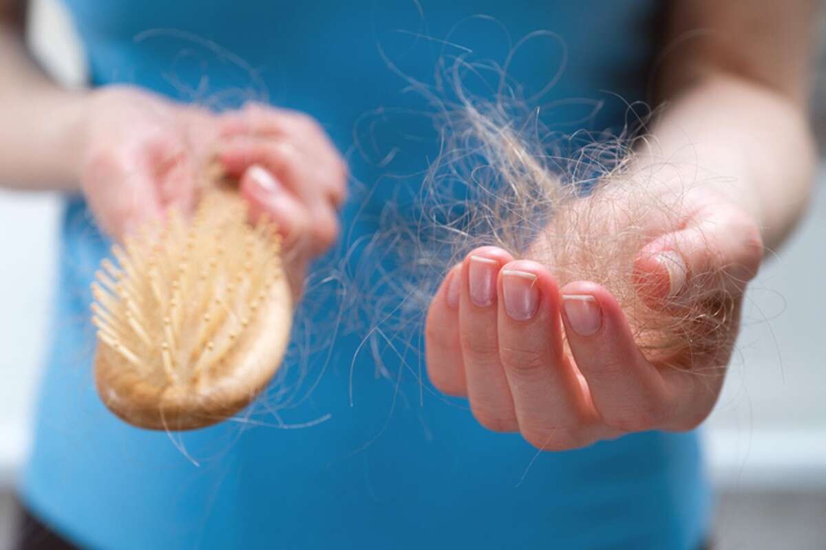 Alopecia: conheça doença que causa queda de cabelo feminina