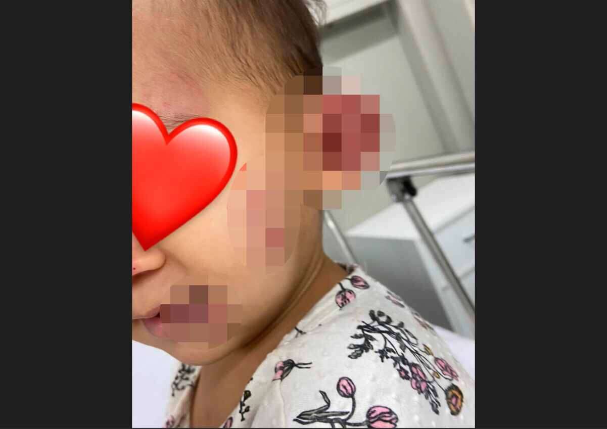 Mãe diz que bebê de 1 ano foi agredida em creche e ficou com hematomas