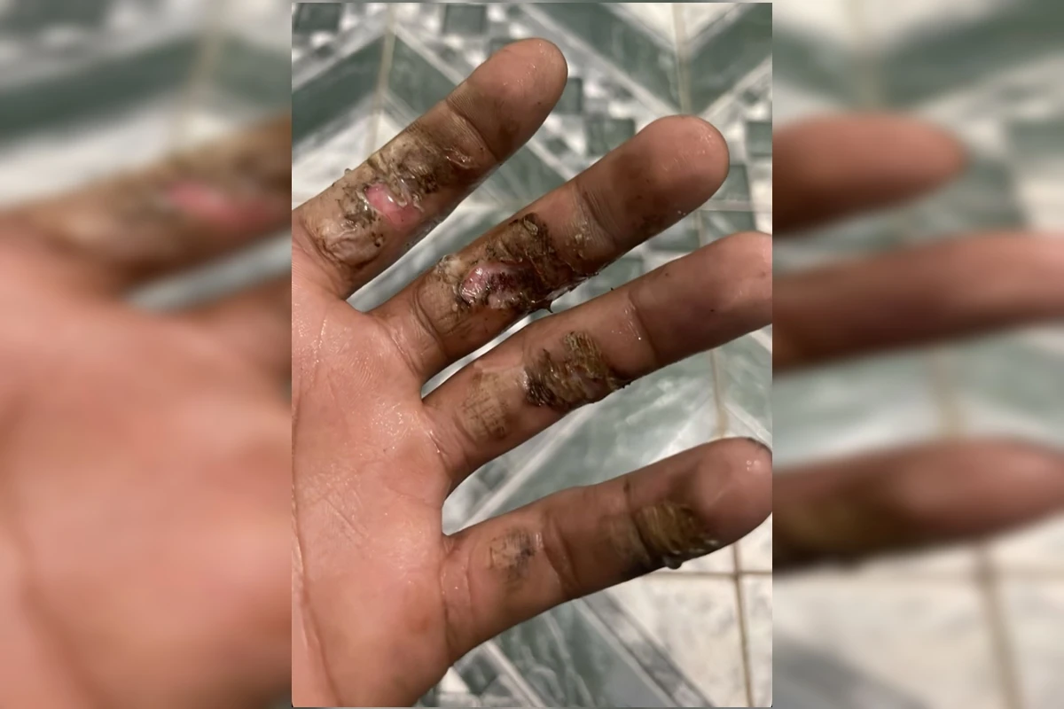 Motorista queima os dedos de uma das mãos após carro pegar fogo no DF