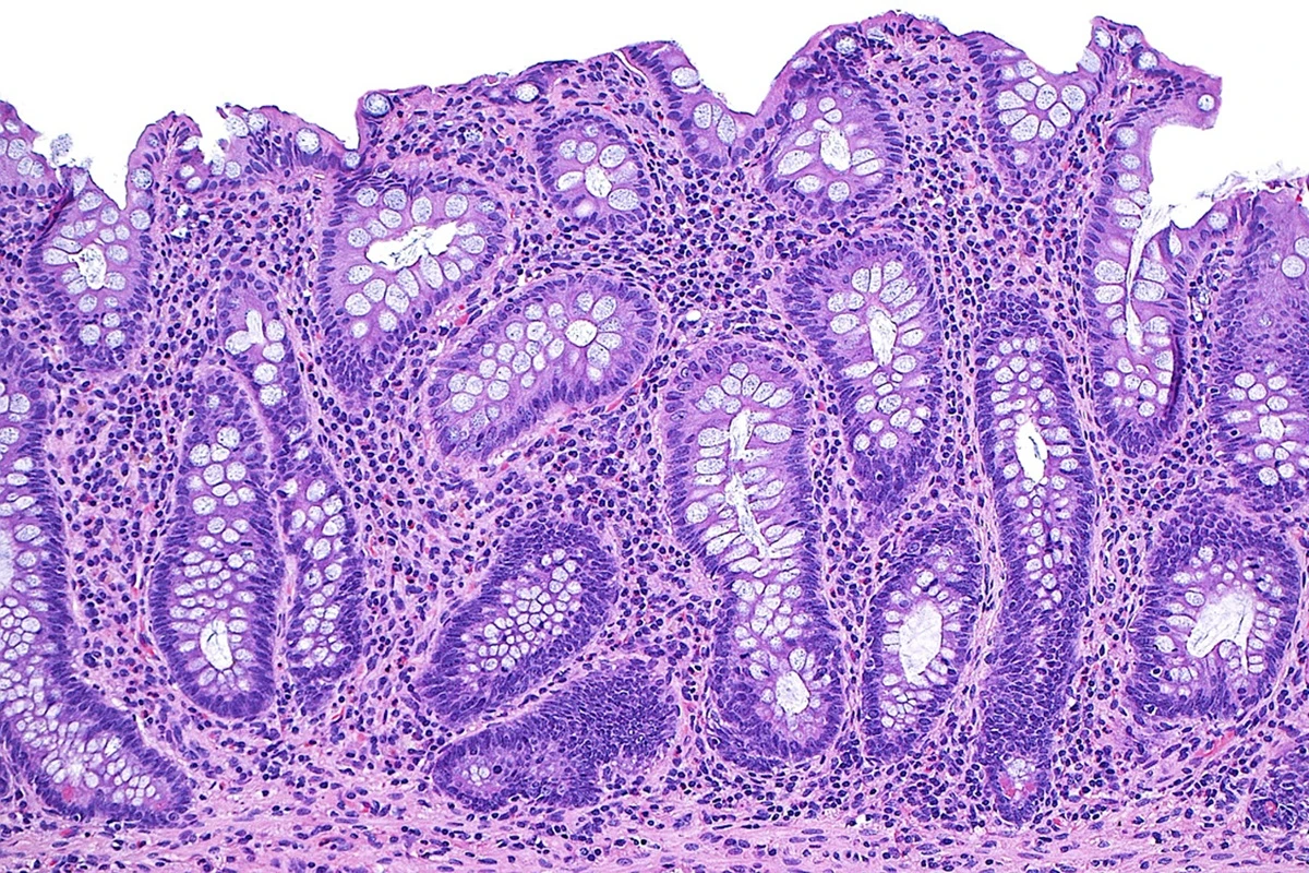 Doenças inflamatórias intestinais não são mais raras e exigem atenção
