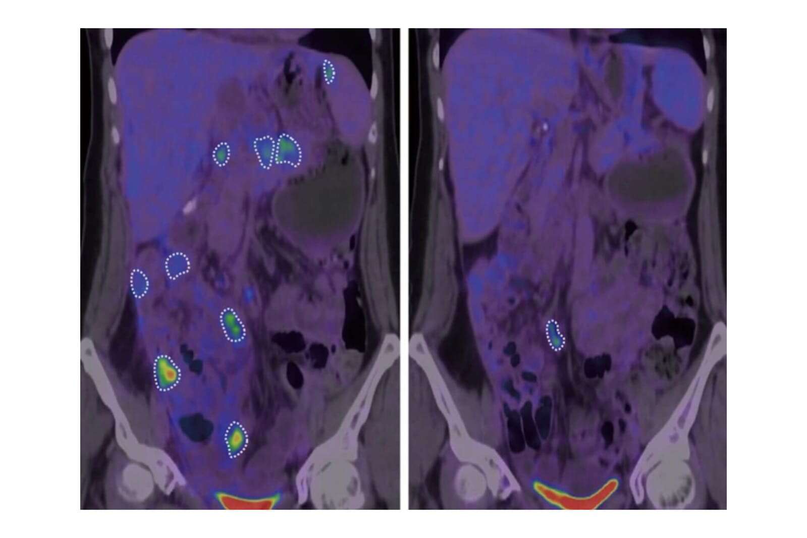 Câncer: estudo sugere tratamento que engana o corpo para atacar tumor