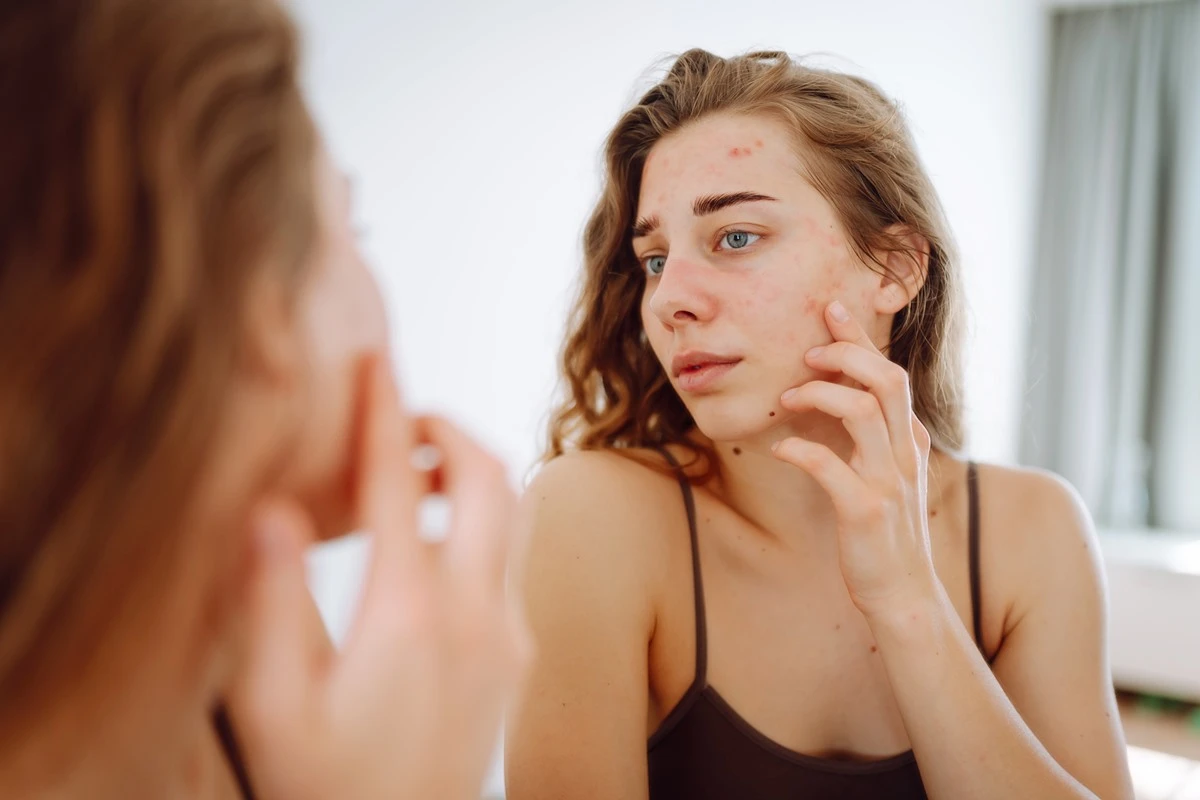 Acne: veja quais alimentos podem piorar o problema e como evitar