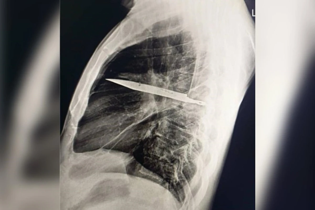 Homem sente dor no peito e descobre faca alojada no corpo há oito anos