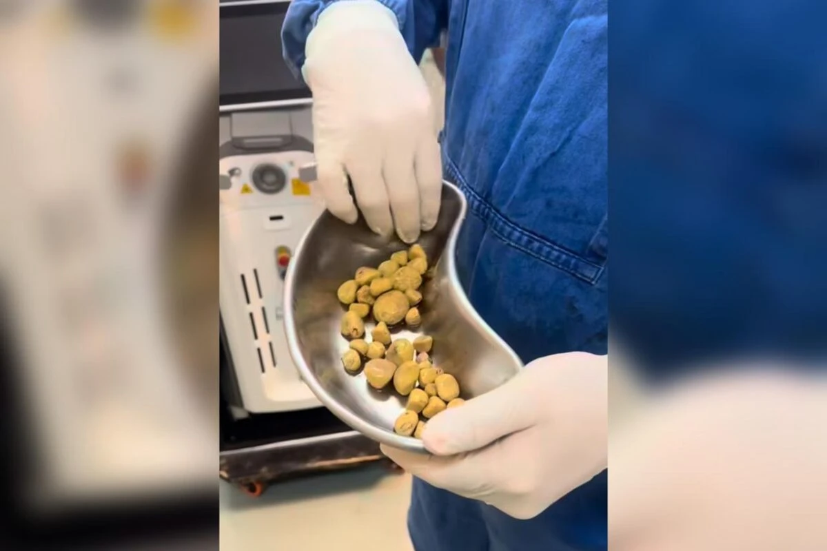 Médico retira 35 pedras da bexiga de homem viciado em refrigerante