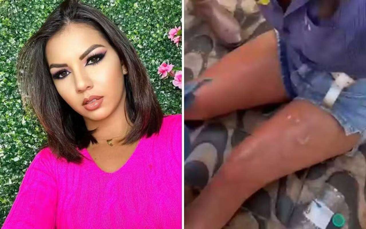 Influencer fica queimada após mulher acender churrasqueira com álcool