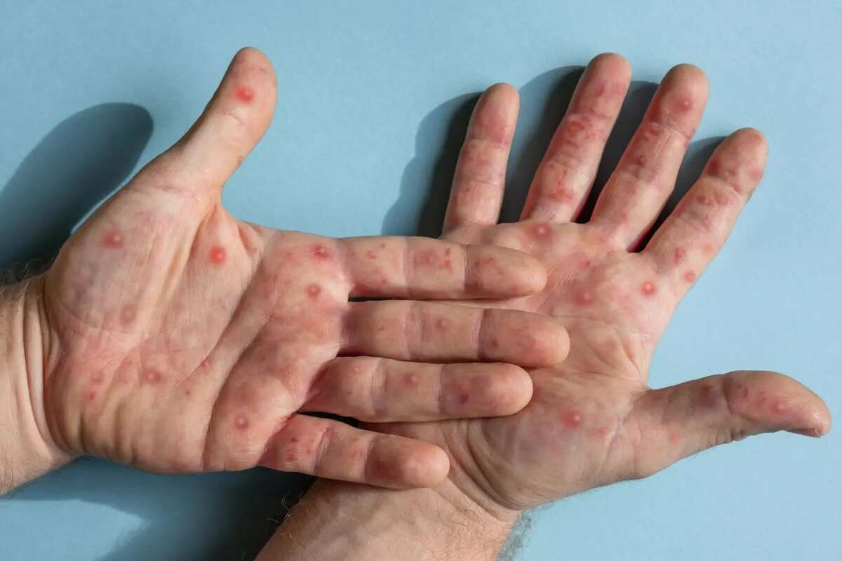 Cidade de São Paulo registra 446 casos de mpox confirmados em 2024