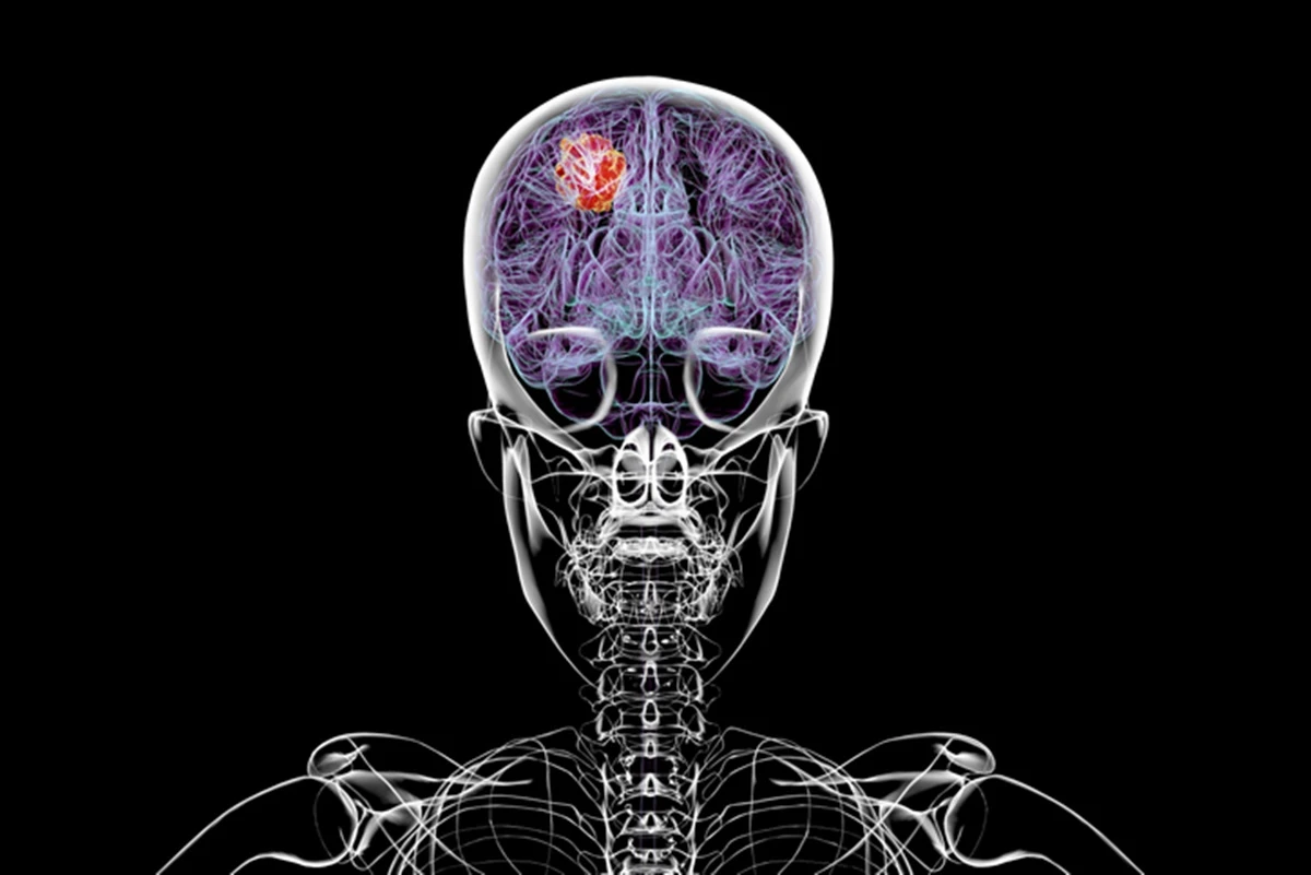 Glioblastoma: câncer cerebral grave corrói o crânio, diz estudo