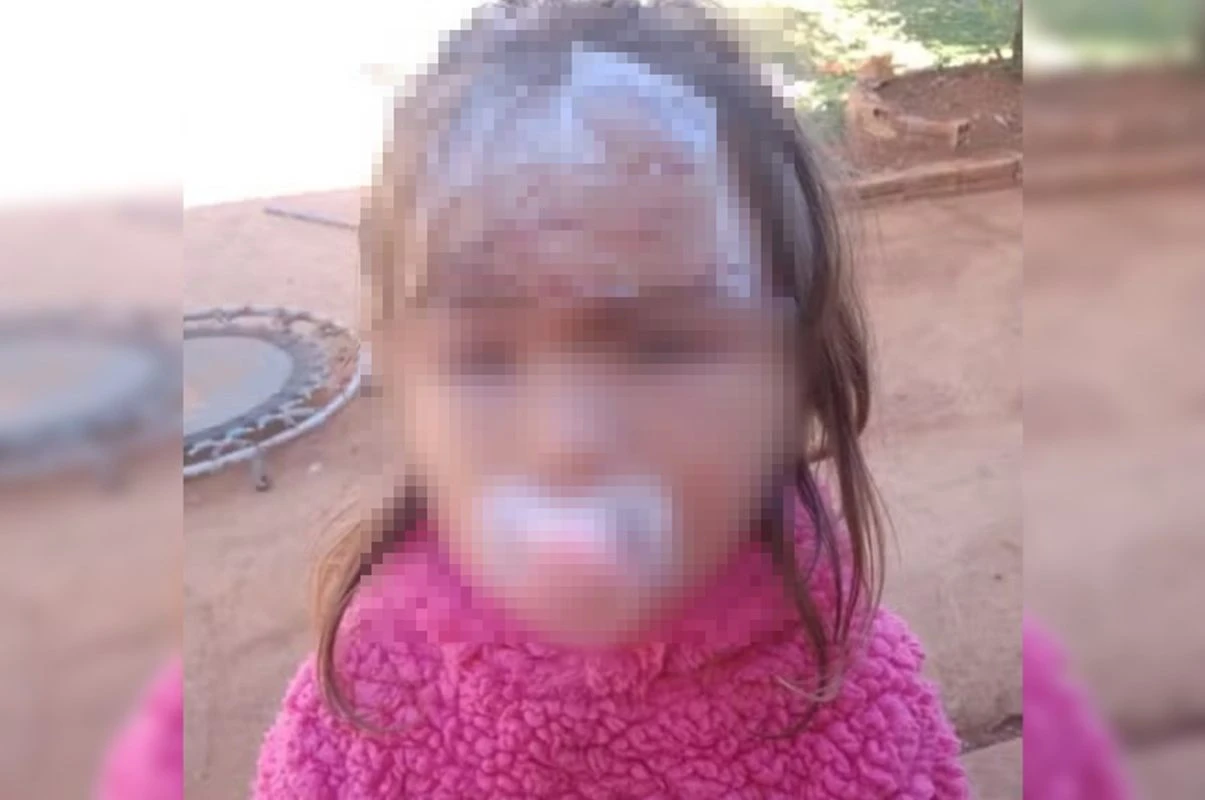 Criança de 3 anos leva 27 pontos no rosto ao ser atacada por cachorro