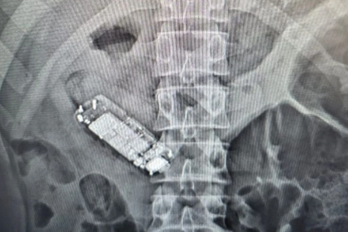 Preso engole minicelular em cadeia e passa por cirurgia para retirada
