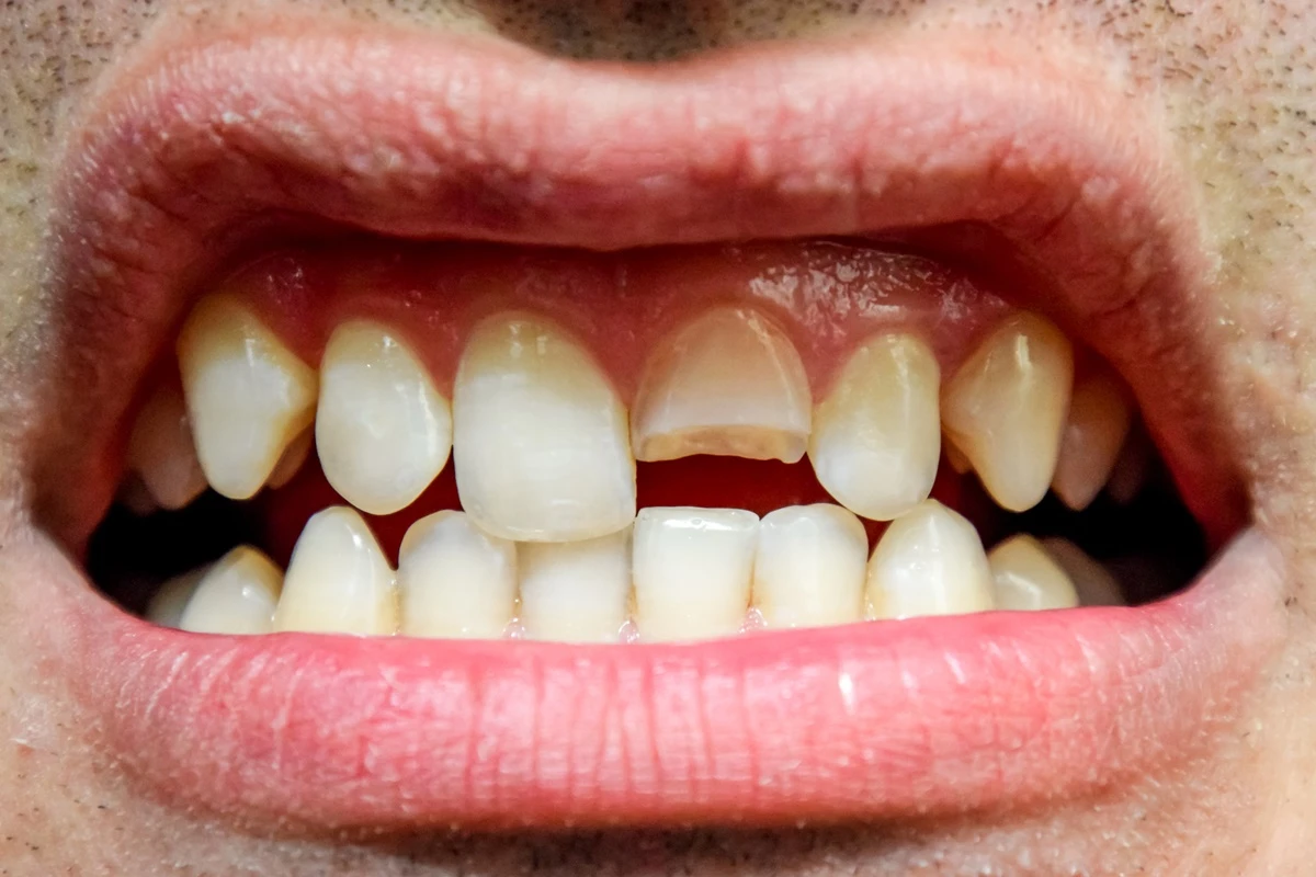Quebrou o dente? Especialista explica como agir nessa situação