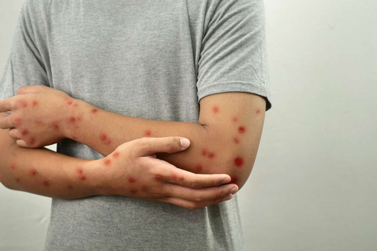 Cidade de São Paulo registra 41 novos casos de mpox em uma semana