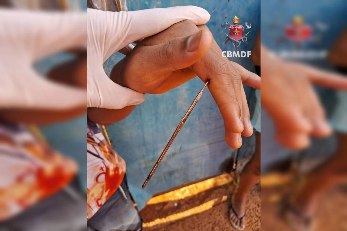 Adolescente fura mão com agulha de crochê e é hospitalizado no DF