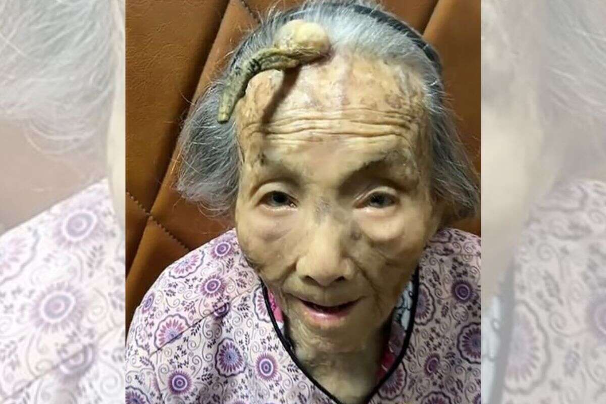 Mulher de 107 anos chama atenção por “chifre” de 10 cm na testa