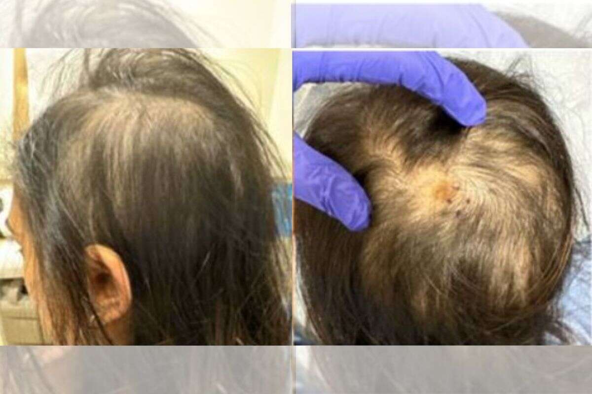 Mulher de 28 anos perde parte do cabelo após ser picada por carrapato