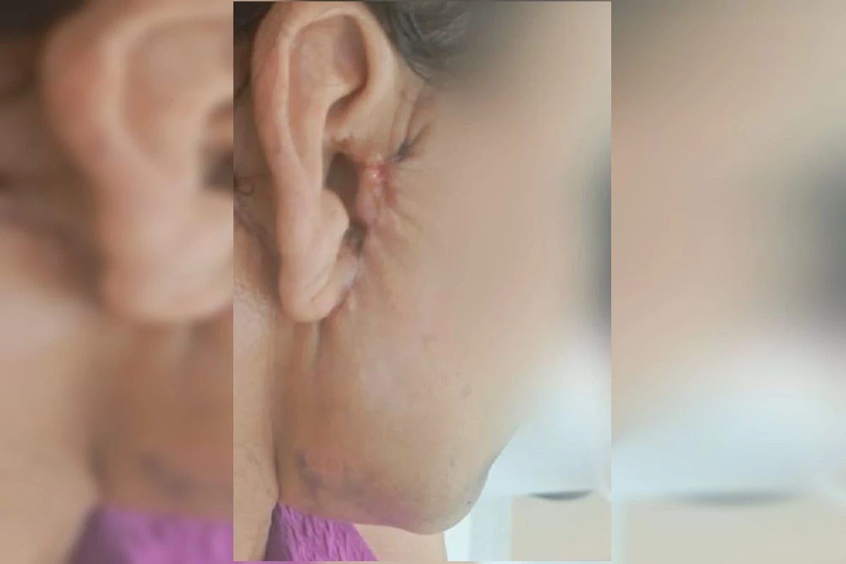 Orelha de paciente ficou deformada após procedimento de dentista em GO
