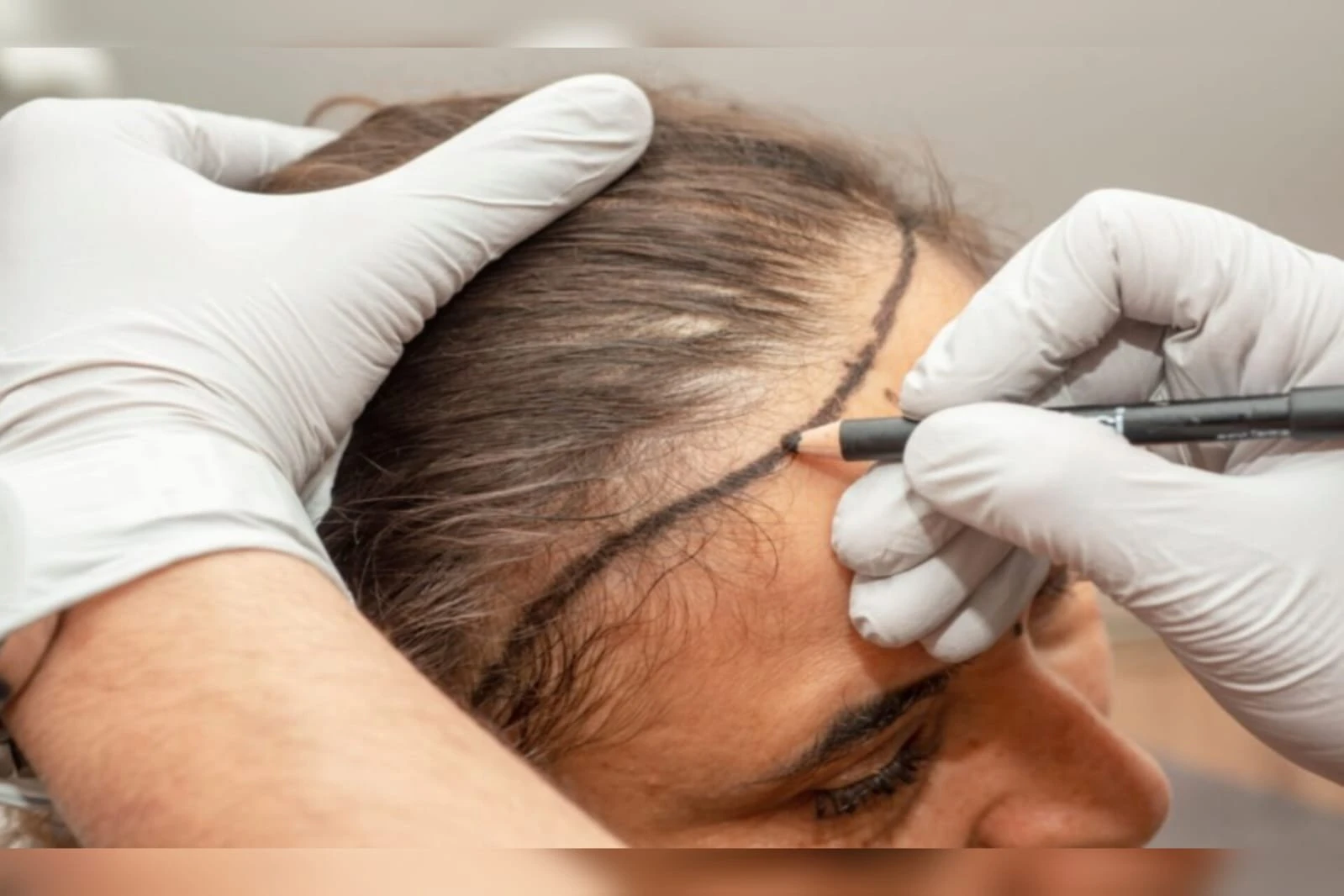 Transplante capilar feminino: veja para quem é indicado e como fazer