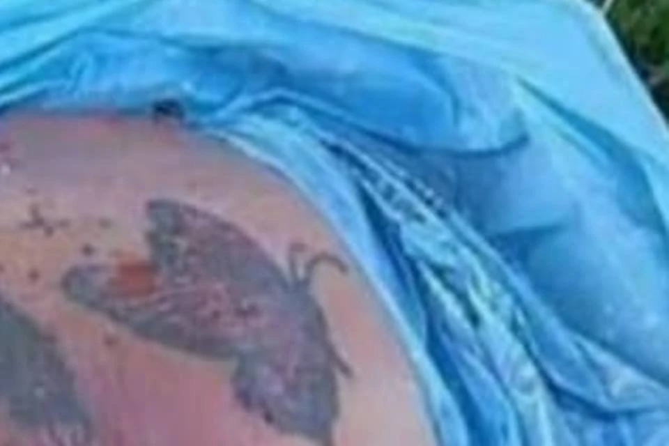 “Corpo” encontrado no DF são restos de pele removidos em cirurgia plástica