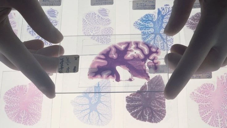 Scoperto il gene che rende il cervello umano così grande