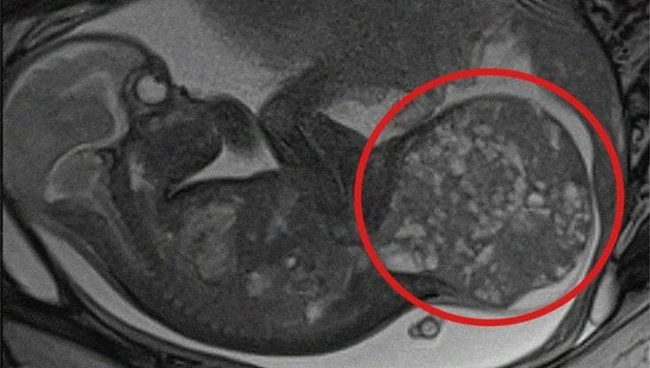 Bimba con tumore di 800 grammi salvata con doppio intervento tra Roma e Milano