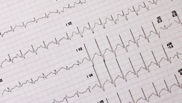 Fibrillazione atriale, un chip sotto la pelle svela l’aritmia invisibile