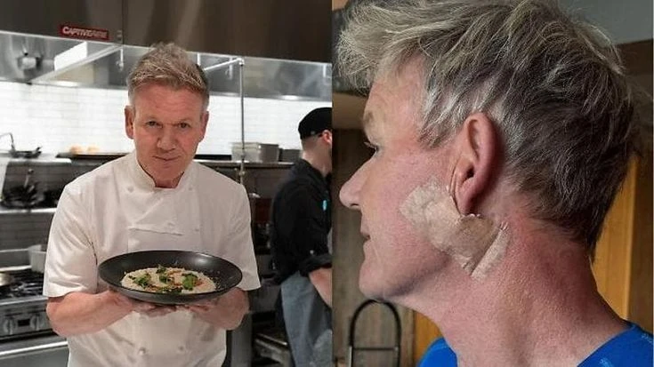 Lo chef Gordon Ramsay: “Ho sconfitto un cancro della pelle”