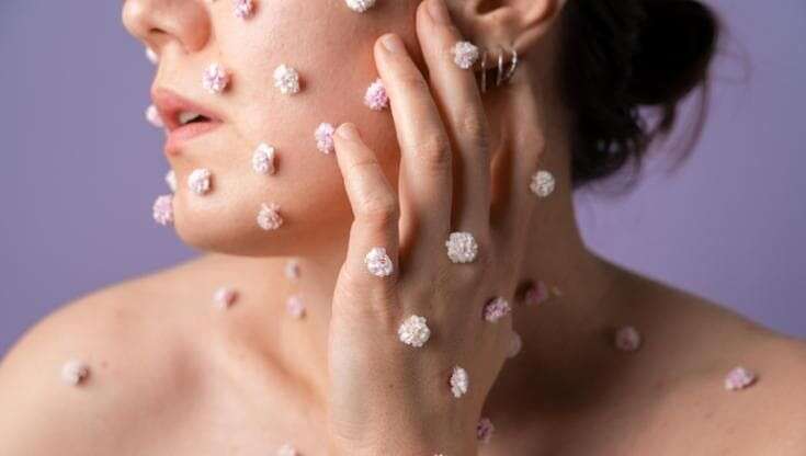 Acne, come affrontare l’effetto rebound da rientro