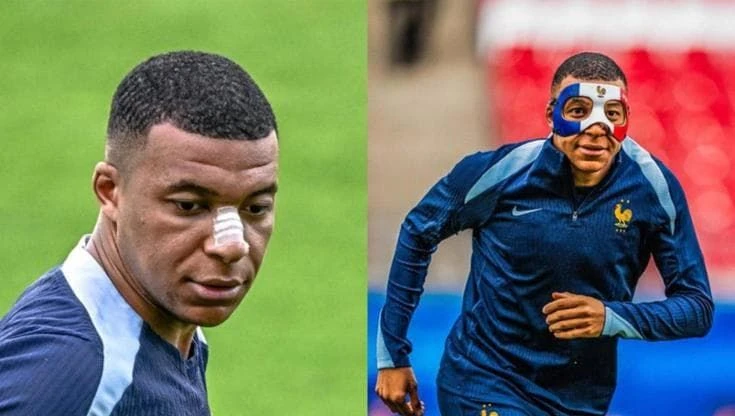 Gli Europei in maschera: ecco i calciatori che l'hanno usata prima di Mbappé