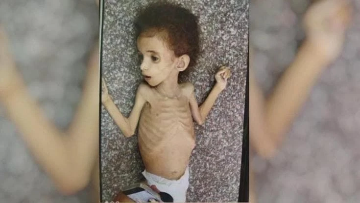 L'immagine di Razan, morta a 4 anni perché non aveva cibo, ci racconta come Gaza sta morendo di fame