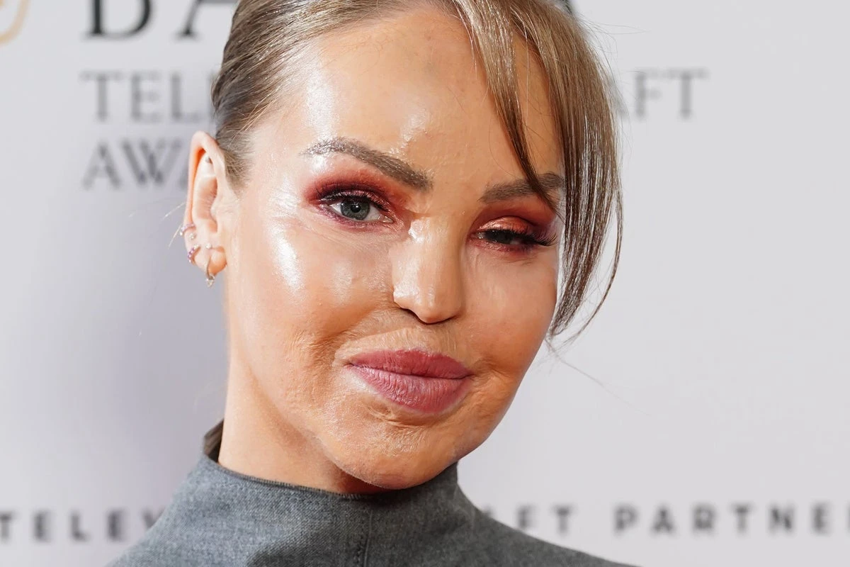 Katie Piper says man threw sandwich at her after noticing facial burns