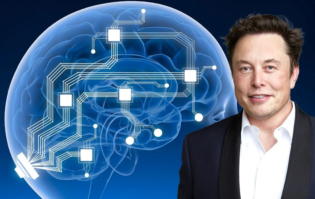 Telepathy: il primo microchip di Neuralink trapiantato in un essere umano. Musk: «Risultati promettenti»