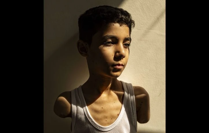 Le portrait d’un enfant palestinien amputé remporte le World Press Photo