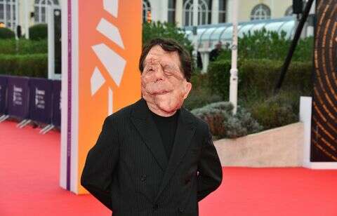 Qu’est-ce que la neurofibromatose dont souffre l’acteur Adam Pearson ?