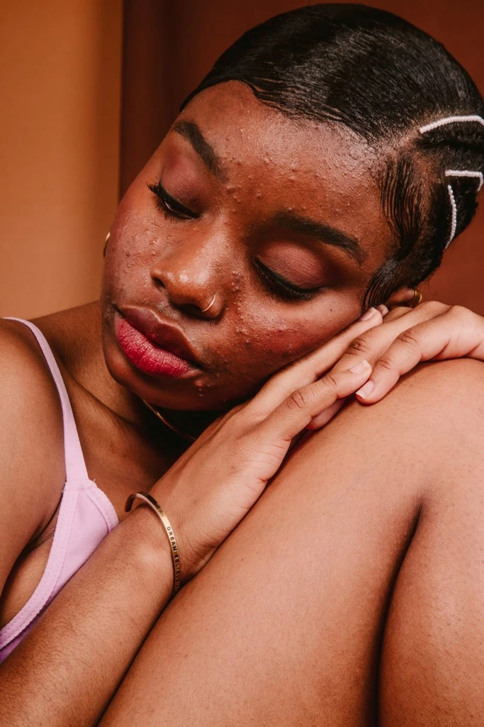A Dermatologist Just Set Me Straight On These 9 Acne Myths