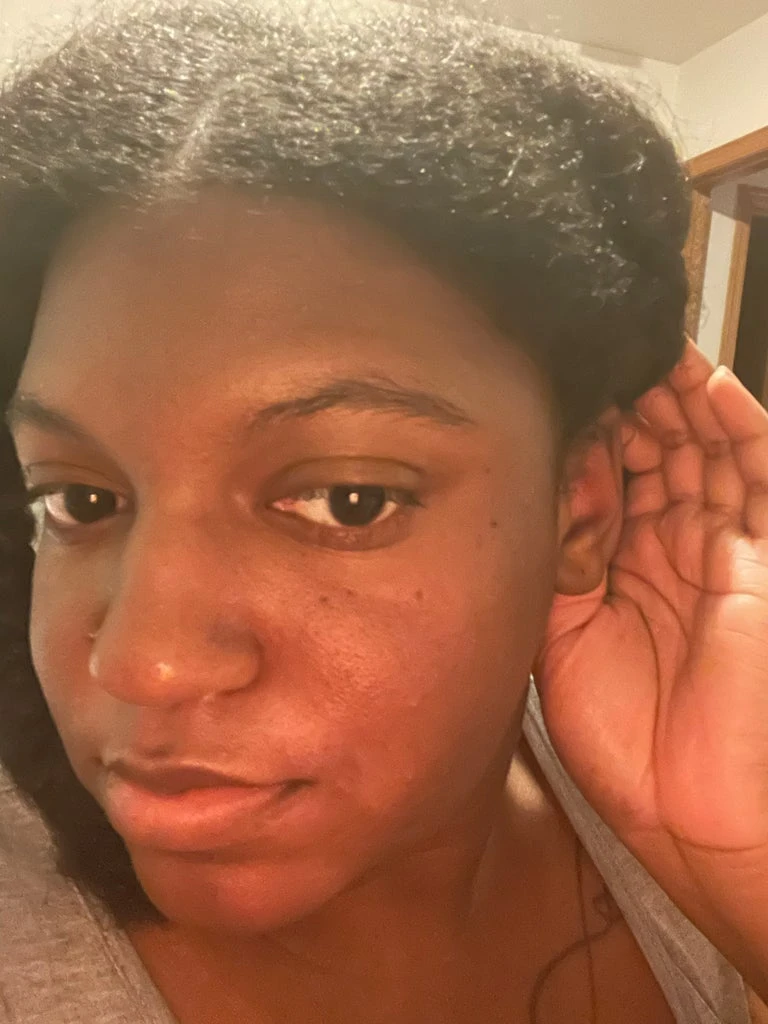 The Chronic Autoimmune Condition You’ve Never Heard Of — But I Live With Every Day