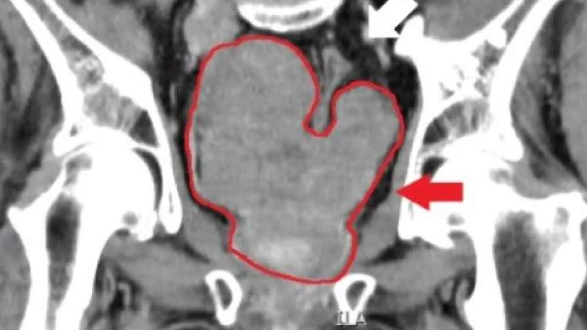 Cambios en tu alimentación que debes aplicar para reducir el riesgo de cáncer de próstata