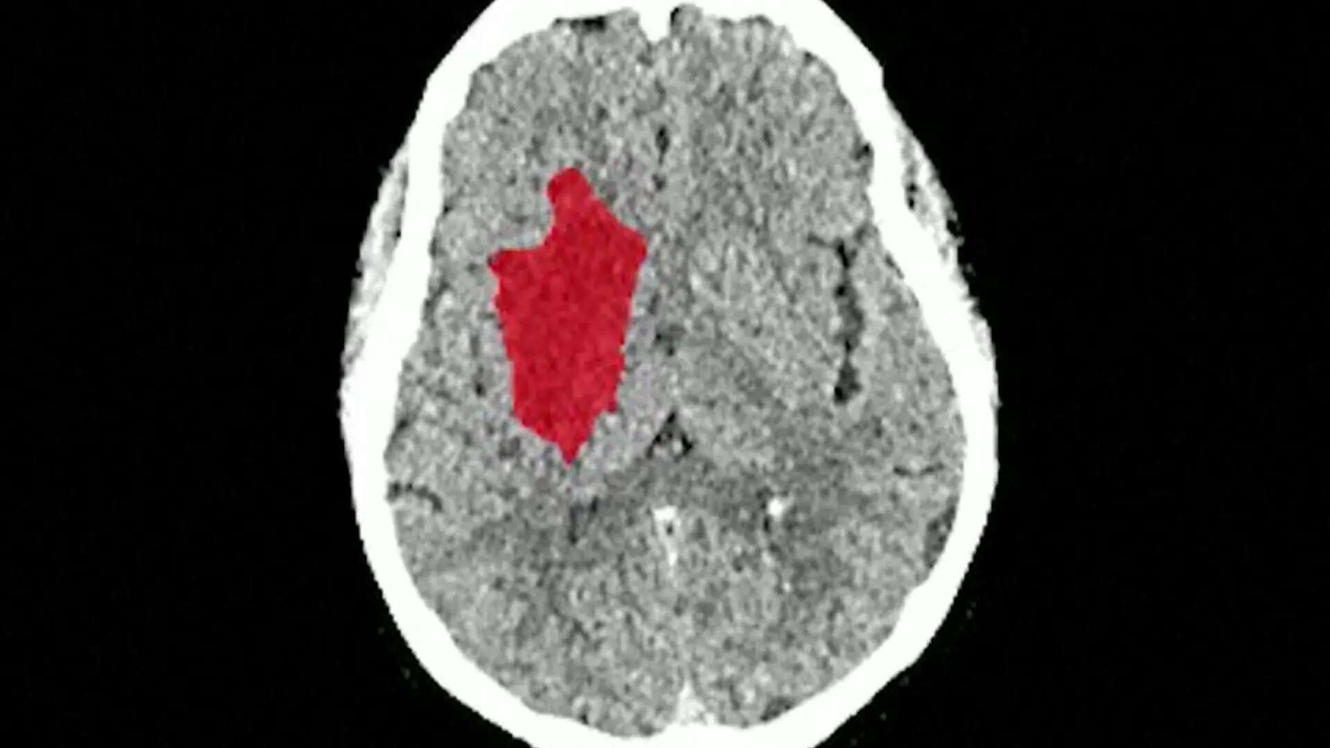 Así es el nuevo software de Inteligencia Artificial que analiza de forma precisa la evolución de los derrames cerebrales