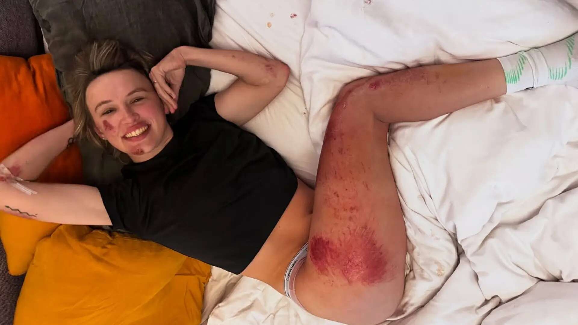 Las impactantes heridas de la ganadora del Tour de Francia tras estrellarse contra un guardarraíl