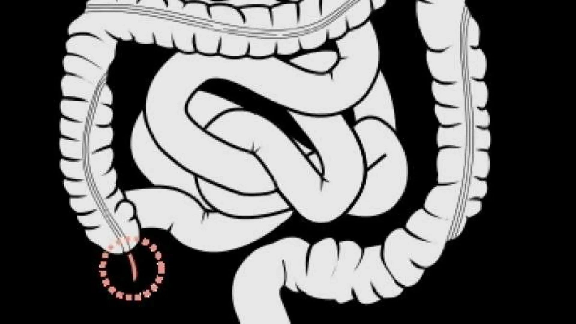La extirpación del apéndice podría reducir el riesgo de padecer cáncer colorrectal