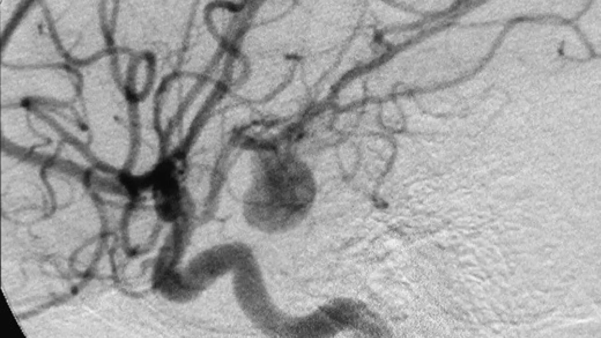 El sutil síntoma de que puedes sufrir un aneurisma y no debes ignorar, según un neurólogo