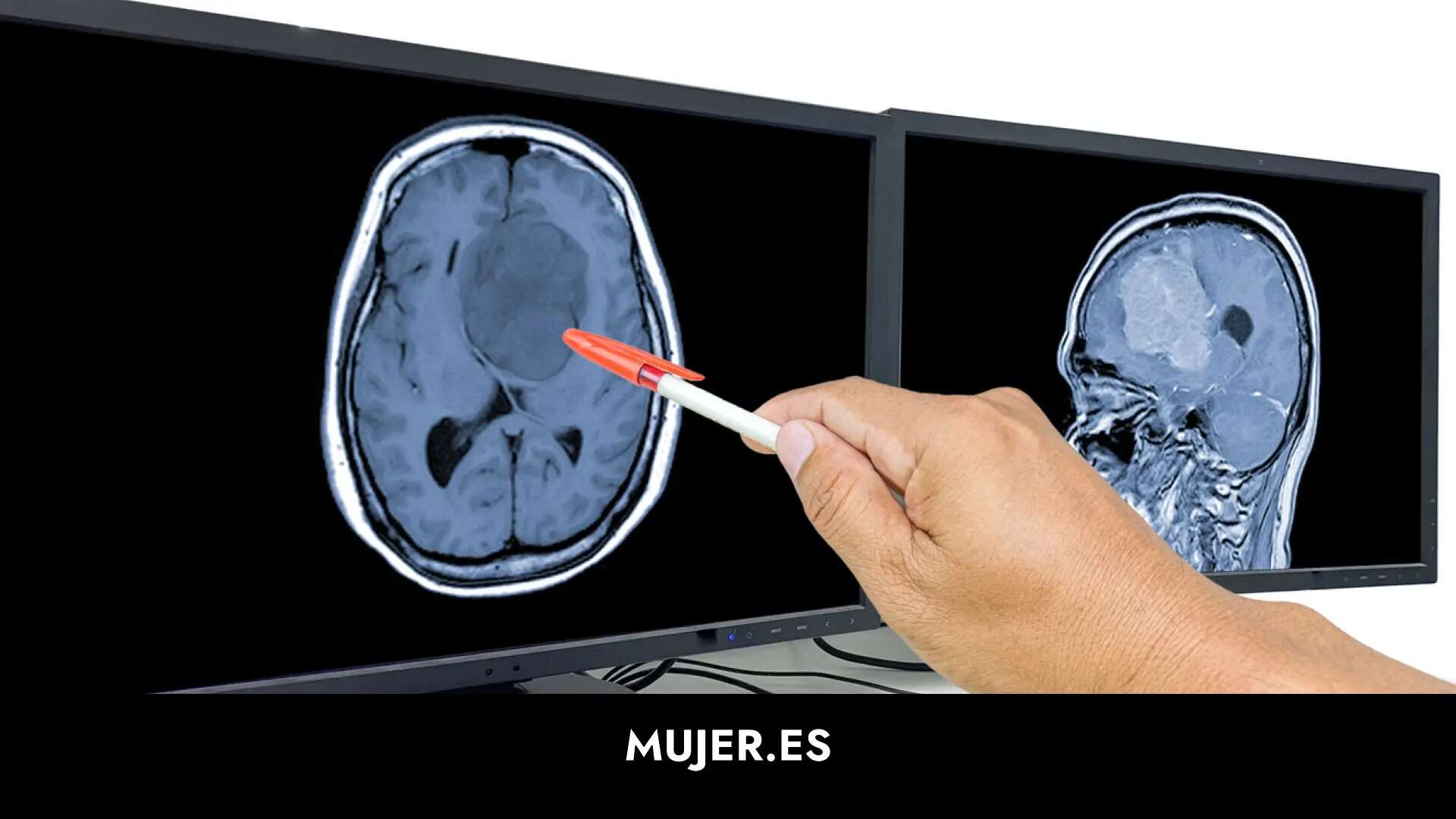 El meningioma: los primeros síntomas del tumor craneal quemás afecta a mujeres