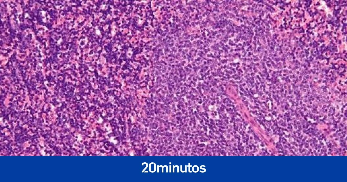 Descubren el gen que causa el cáncer de leucemia linfocítica crónica: más del 80% de los enfermos lo contiene