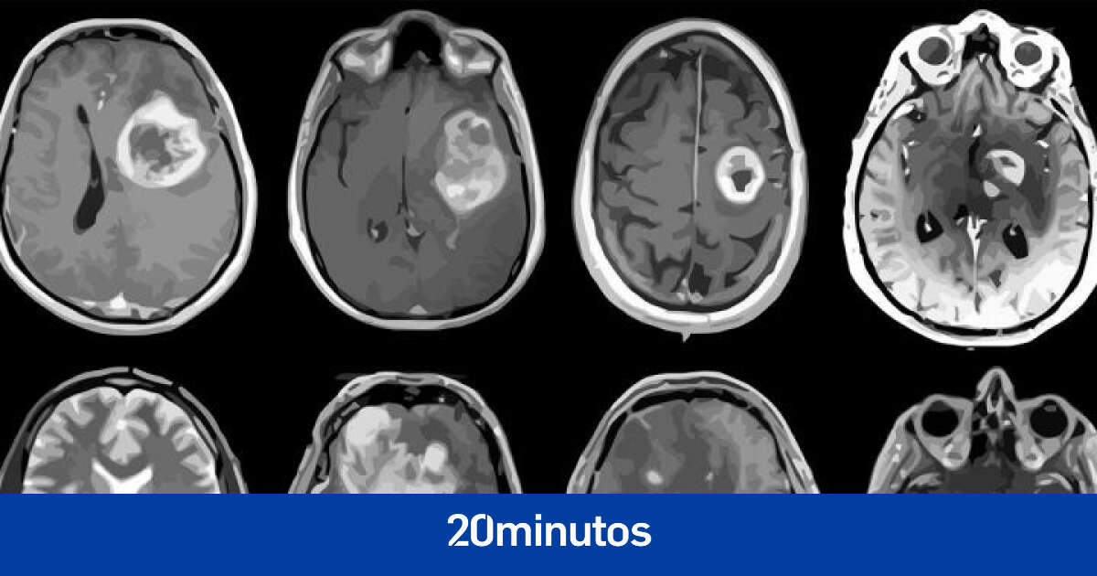 Investigan la curación del tumor cerebral más común y con peor pronóstico, el gliobastoma multiforme