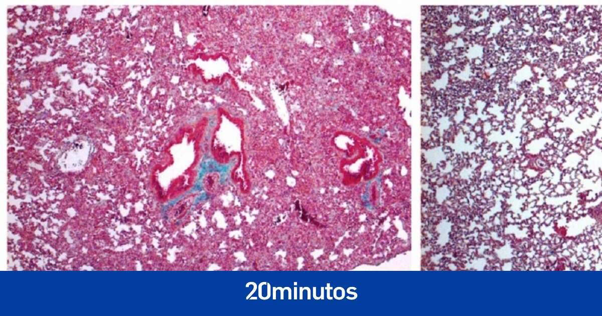 Investigadores españoles identifican una molécula que podría tratar los daños pulmonares causados por el covid